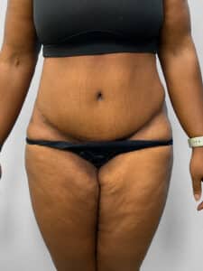 After Image: Tummy Tuck – Dr. Howell