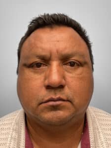 After Image: Lower Blepharoplasty – Dr. Howell