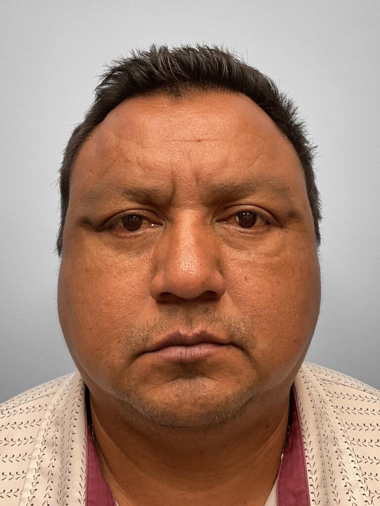 After Image: Lower Blepharoplasty – Dr. Howell - front