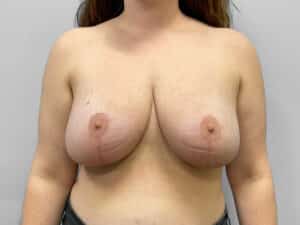 After Image: Breast Reduction – Dr. Howell