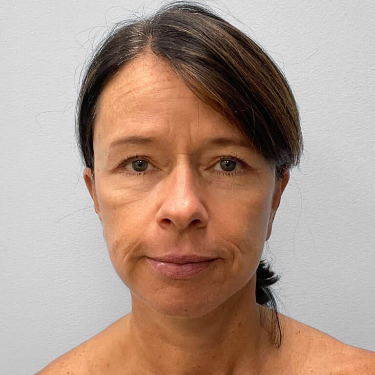 After Image: Facelift & Laser Resurfacing – Dr. Howell - front
