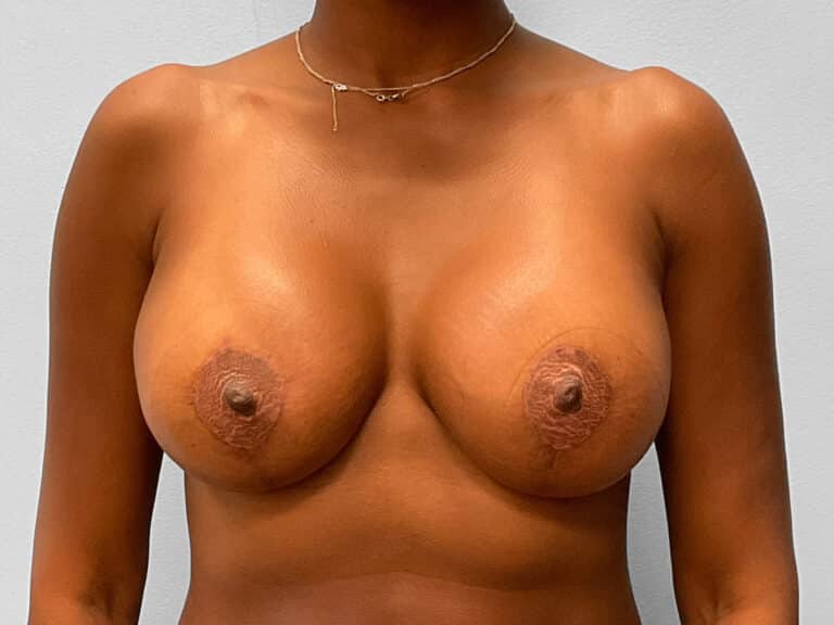 After Image: Breast Augmentation & Lift – Dr. Howell - front