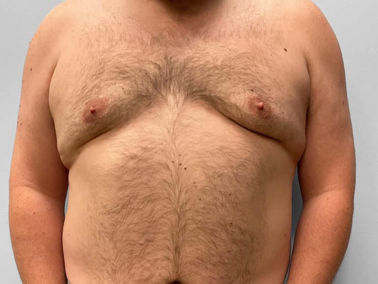 After Image: Gynecomastia Surgery – Dr. Howell - front