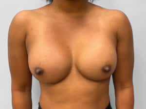 After Image: Breast Augmentation- Dr. Howell