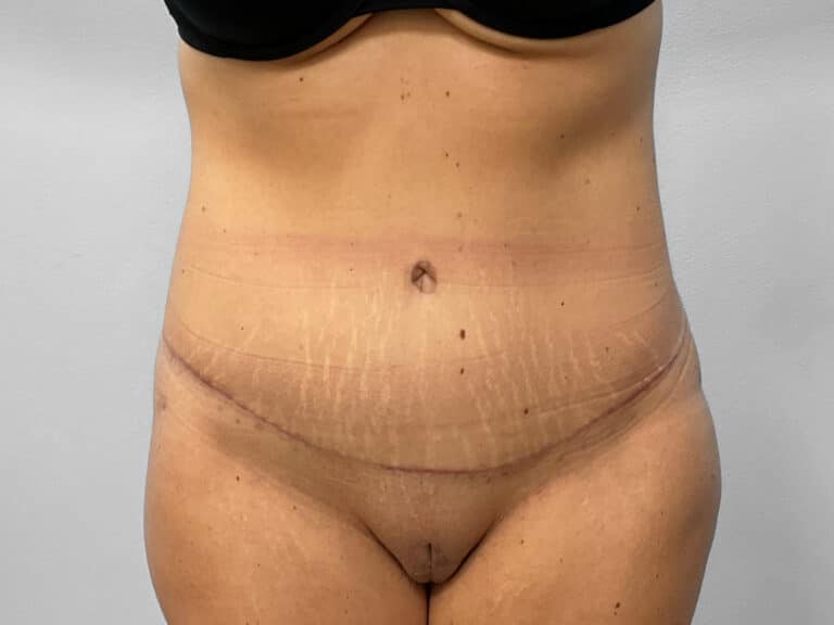 After Image: Tummy Tuck – Dr. Howell - front