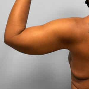 After Image: Arm Lift – Dr. Howell