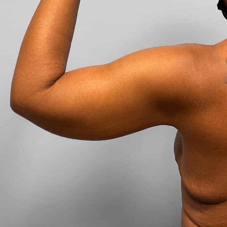 After Image: Arm Lift – Dr. Howell - back
