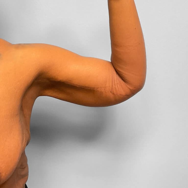After Image: Arm Lift – Dr. Howell - front