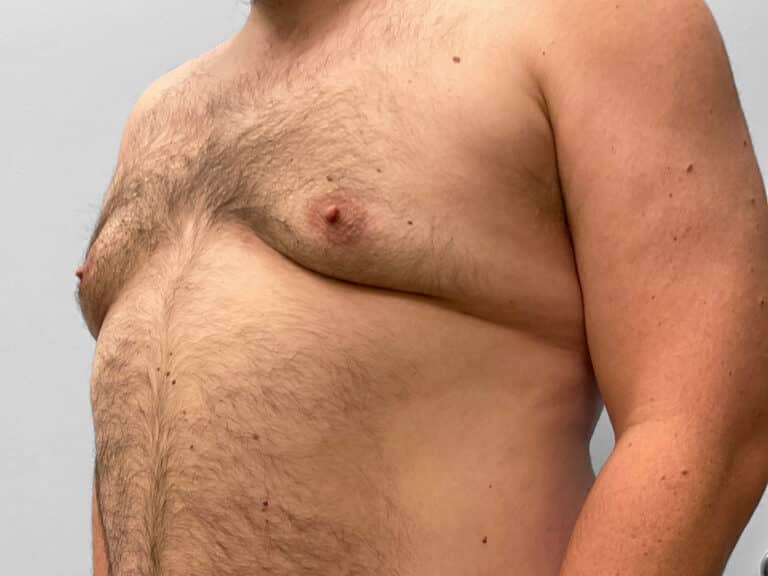 After Image: Gynecomastia Surgery – Dr. Howell - left-front-oblique