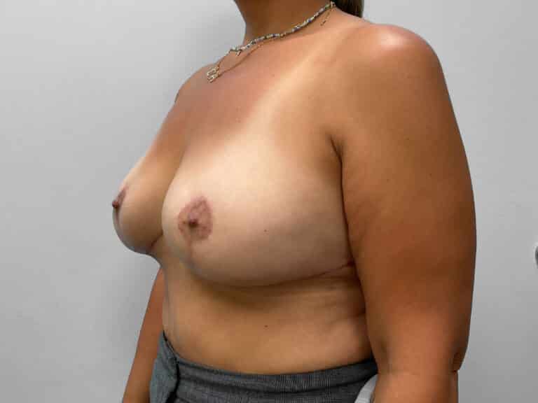 After Image: Explant – Dr. Howell - left-front-oblique
