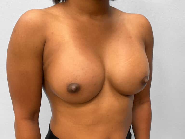 After Image: Breast Augmentation- Dr. Howell - right-front-oblique
