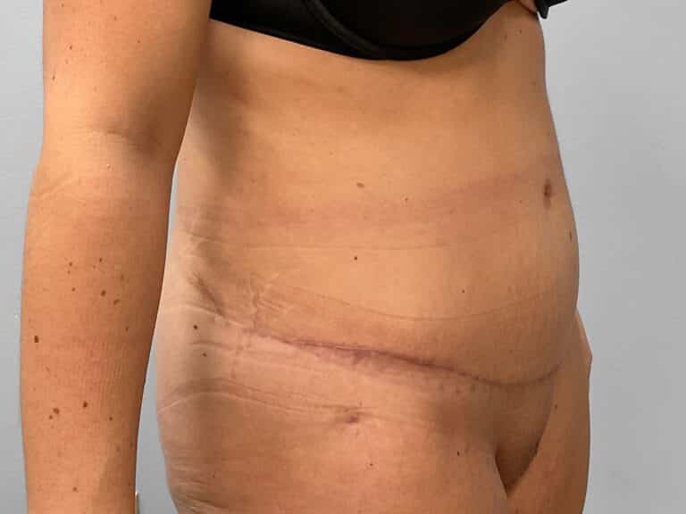 After Image: Tummy Tuck – Dr. Howell - right-front-oblique