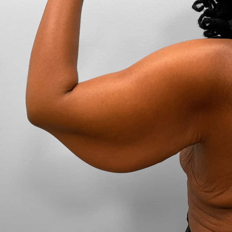 Before Image: Arm Lift – Dr. Howell - back