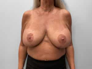 Before Image: Breast Enhancement – Dr. Howell