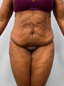 Before Image: Tummy Tuck – Dr. Howell