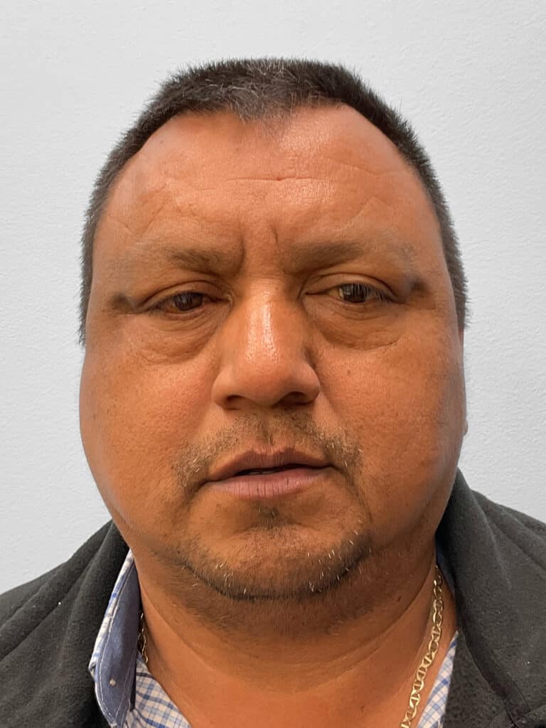 Before Image: Lower Blepharoplasty – Dr. Howell - front