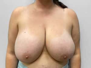 Before Image: Breast Reduction – Dr. Howell