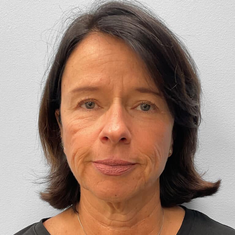 Before Image: Facelift & Laser Resurfacing – Dr. Howell - front