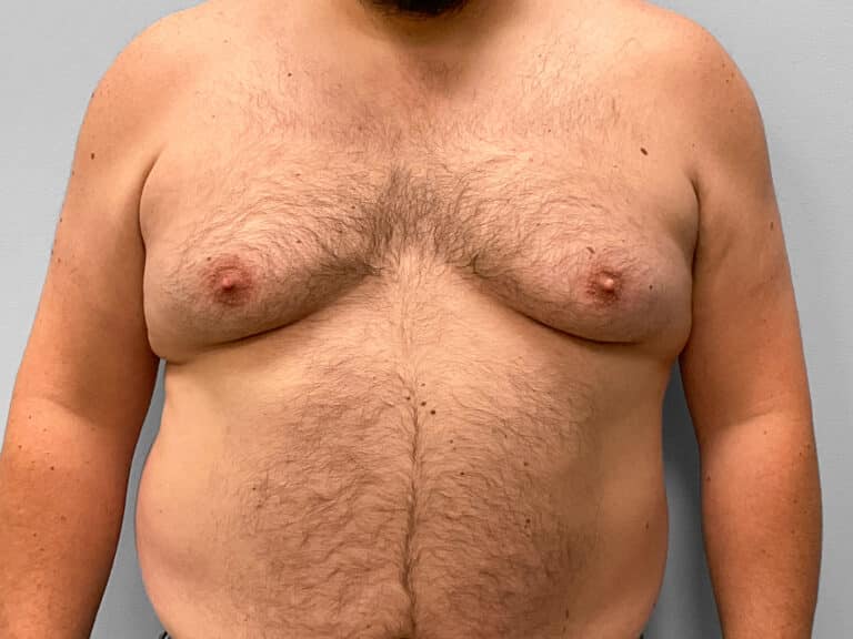Before Image: Gynecomastia Surgery – Dr. Howell - front
