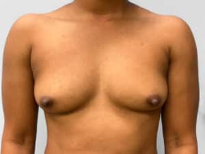 Before Image: Breast Augmentation- Dr. Howell