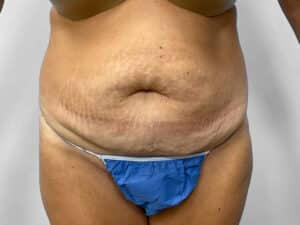 Before Image: Tummy Tuck – Dr. Howell