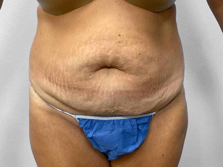 Before Image: Tummy Tuck – Dr. Howell - front