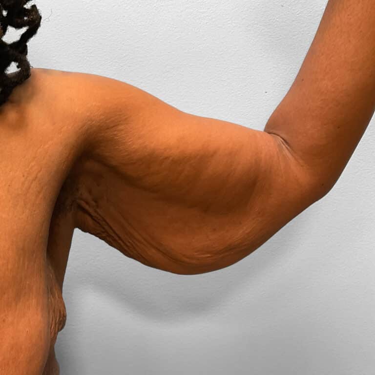 Before Image: Arm Lift – Dr. Howell - front
