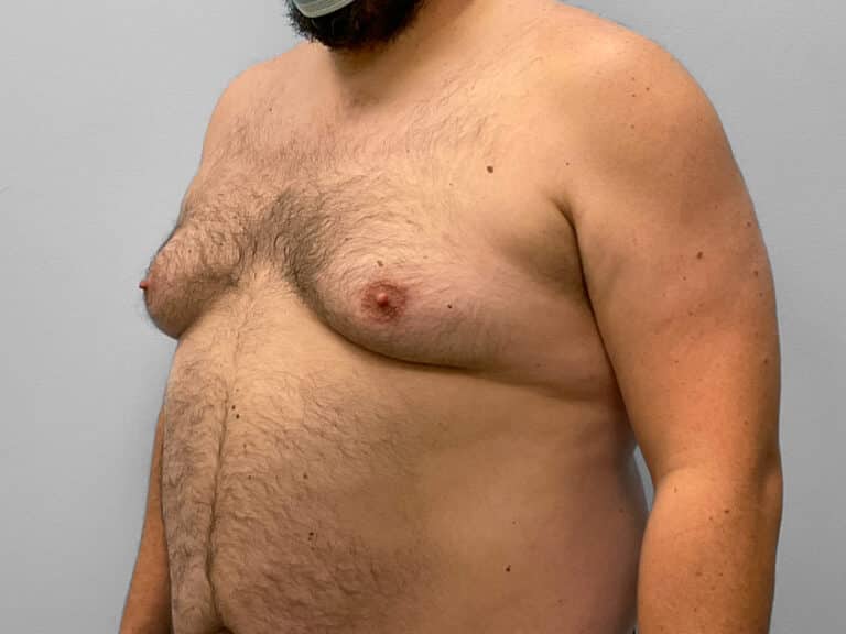 Before Image: Gynecomastia Surgery – Dr. Howell - left-front-oblique