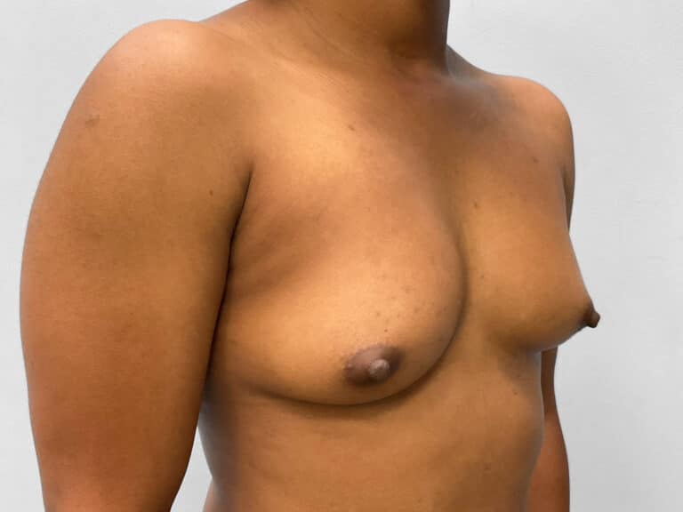 Before Image: Breast Augmentation- Dr. Howell - right-front-oblique