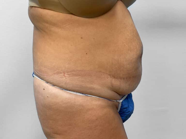 Before Image: Tummy Tuck – Dr. Howell - right-front-oblique