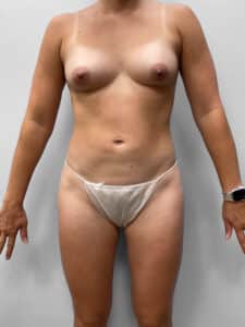 After Image: Tummy Tuck