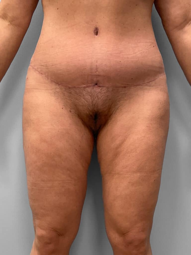 After Image: Tummy Tuck – Dr. Howell - front