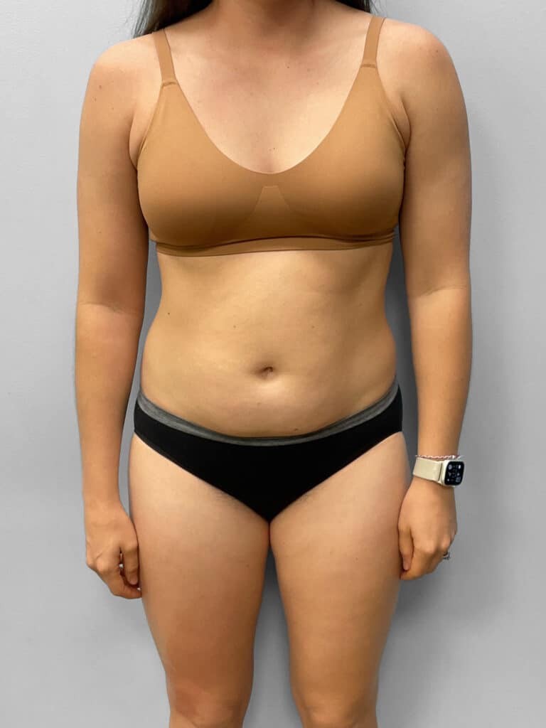 Before Image: Tummy Tuck - front