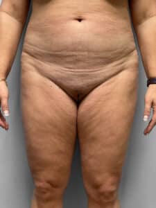 Before Image: Tummy Tuck – Dr. Howell