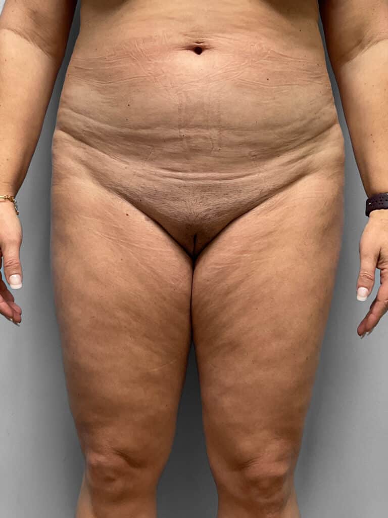 Before Image: Tummy Tuck – Dr. Howell - front