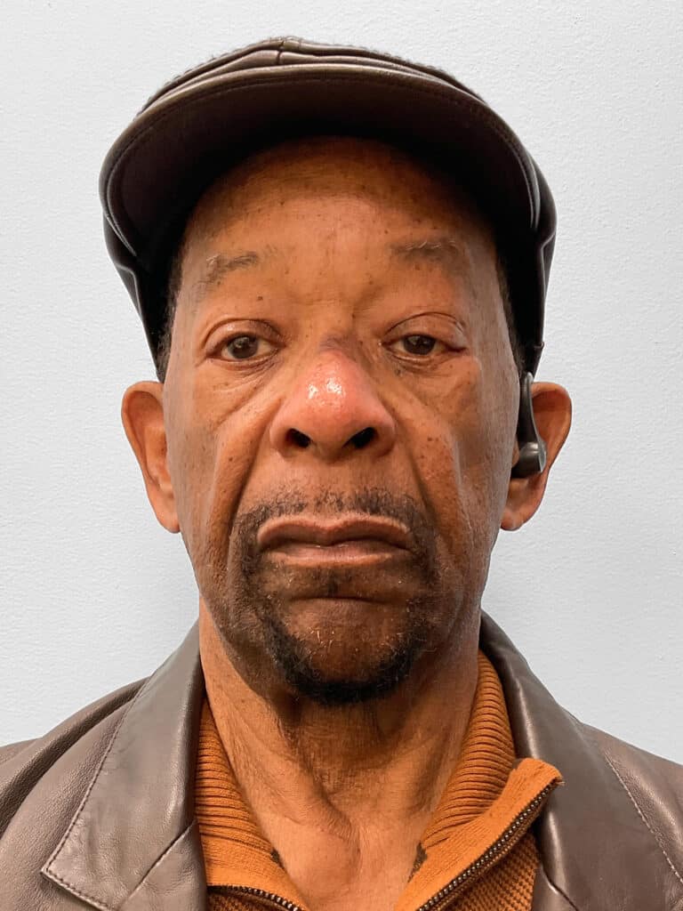 After Image: Lower Blepharoplasty – Dr. Tucker - front