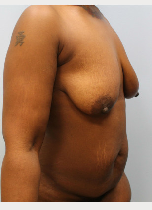 Before Image: Mommy Makeover – Dr. Howell - other