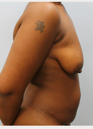 Before Image: Mommy Makeover – Dr. Howell - other