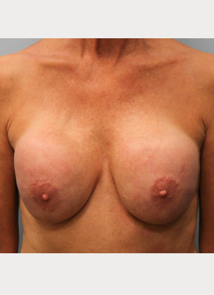 Before Image: Breast Augmentation Revision – Dr. Tucker - front