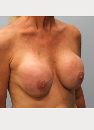 Before Image: Breast Augmentation Revision – Dr. Tucker - right-front-oblique