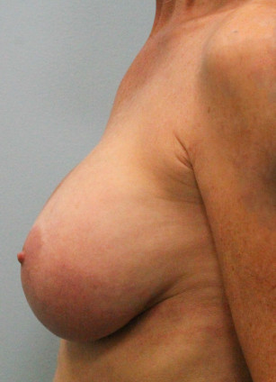 After Image: Breast Augmentation Revision – Dr. Tucker - left-side