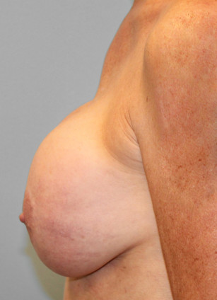 Before Image: Breast Augmentation Revision – Dr. Tucker - left-side