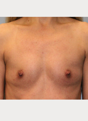 Before Image: Breast Augmentation – Dr. Howell - front