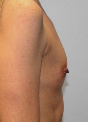 Before Image: Breast Augmentation – Dr. Howell - right-side