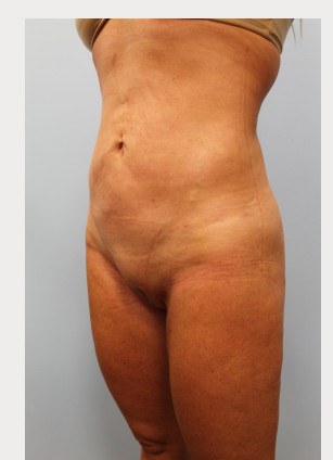 After Image: Liposuction – Dr. Howell - other