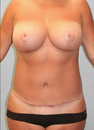 After Image: Mommy Makeover & Mastopexy – Dr. Howell - front