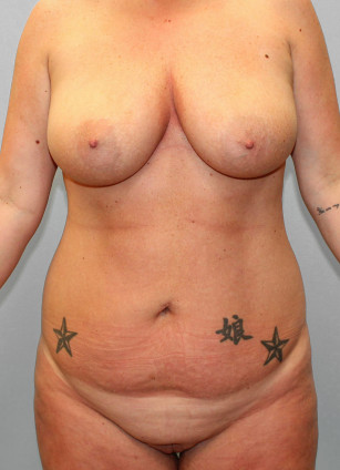 Before Image: Mommy Makeover & Mastopexy – Dr. Howell - front