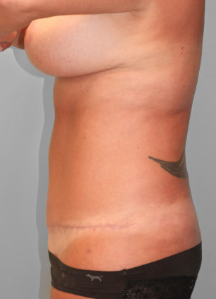After Image: Mommy Makeover & Mastopexy – Dr. Howell - left-side