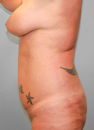 Before Image: Mommy Makeover & Mastopexy – Dr. Howell - left-side
