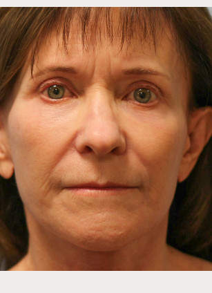 After Image: Facelift & Blepharoplasty – Dr. Howell - front